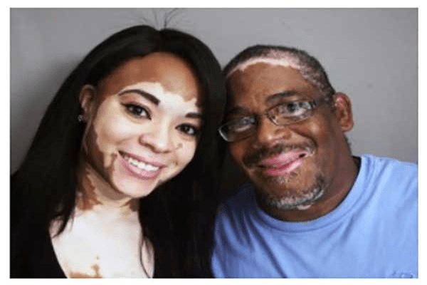 el-vitiligo-la-aparicion-y-sus-causas-que-tratamiento_1493320179