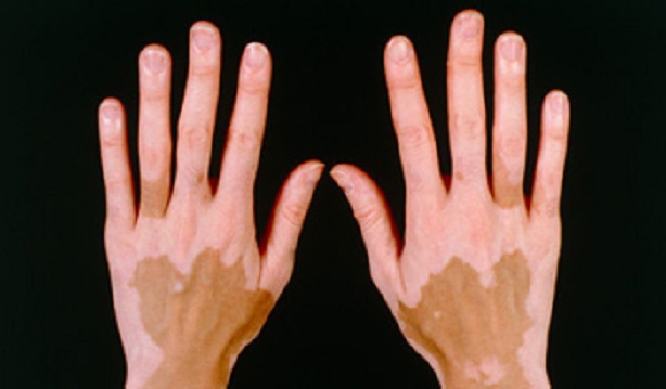 vitiligo2