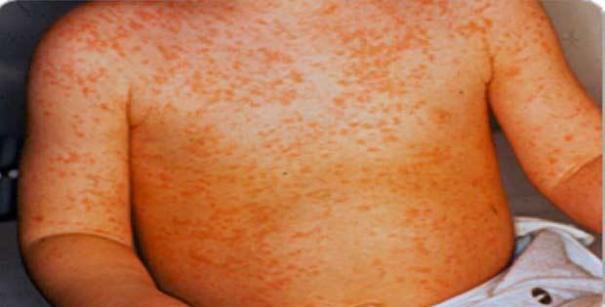 Remedio-para-el-sarpullido