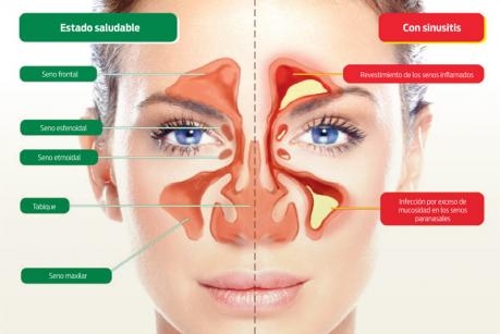 1526465863_archive_sinusitis