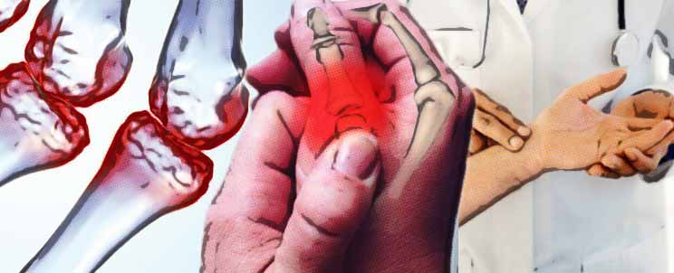 sintomas-del-reuma-en-las-manos