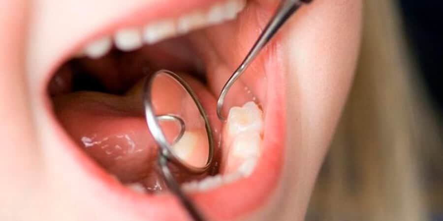 tratar-enfermedad-bucal-caries