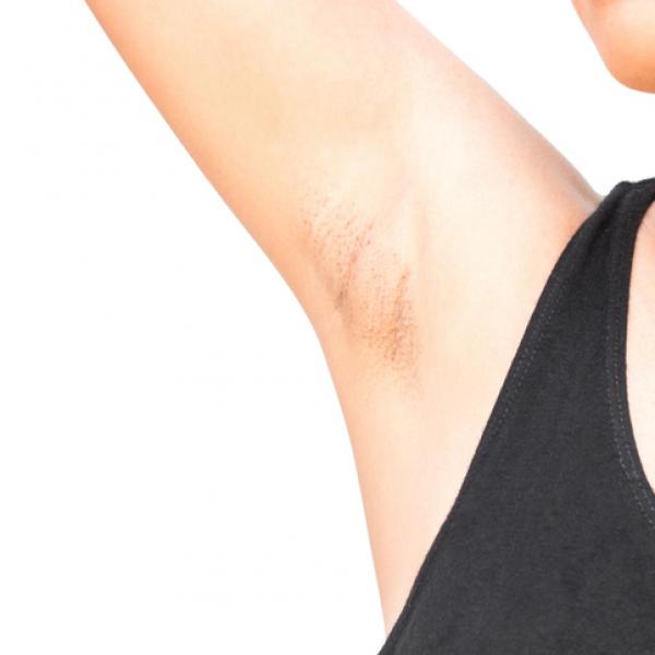 como_blanquear_las_axilas_rapido_49445_600_square