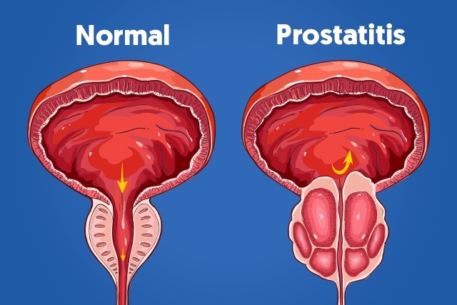 prostatitis_16424_l (1)