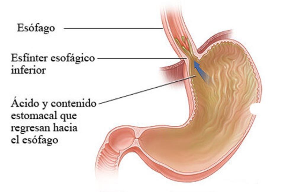Reflujo-gastroesofágico