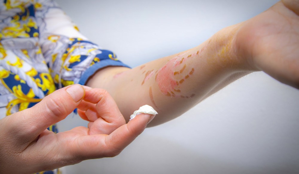 remedios-caseros-contra-quemaduras