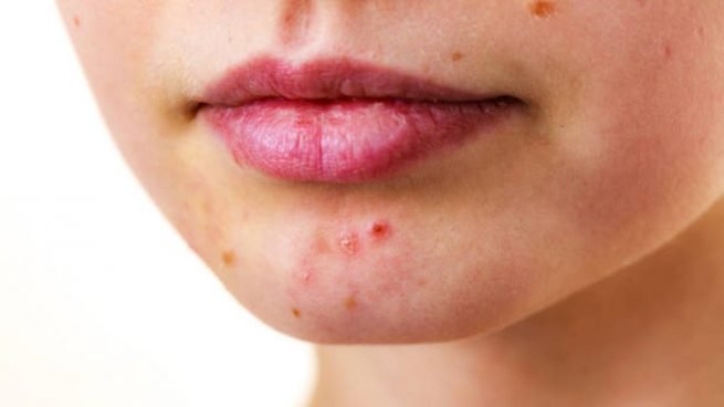 como-tratar-y-como-eliminar-el-acne-en-la-barbilla-655x368