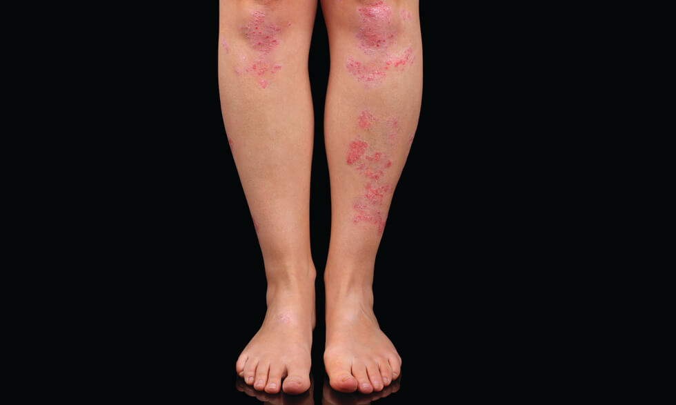 questionsandanswersaboutpsoriasis-sp17