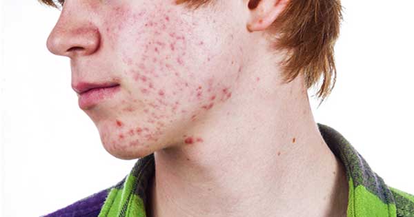 todo-deben-saber-adolescentes-acne-regreso-clases